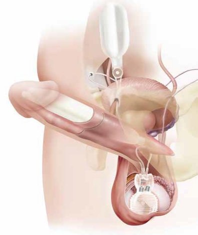 grafico che mostra l'inserimento di una protesi peniena idraulica